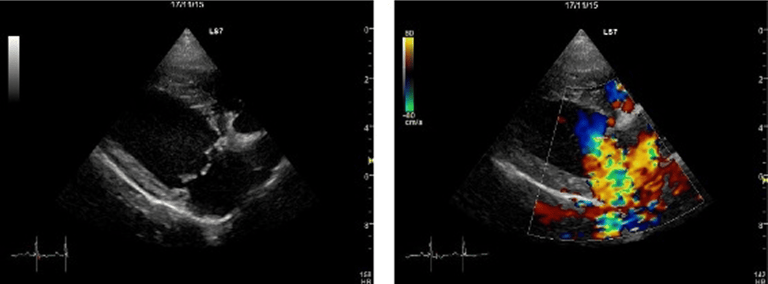 僧帽弁形成術術前