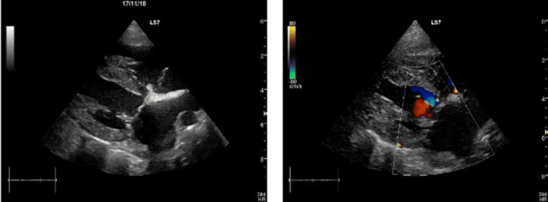 僧帽弁形成術術後