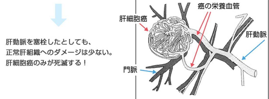 なぜ肝細胞癌に対して動脈塞栓術を行うのか