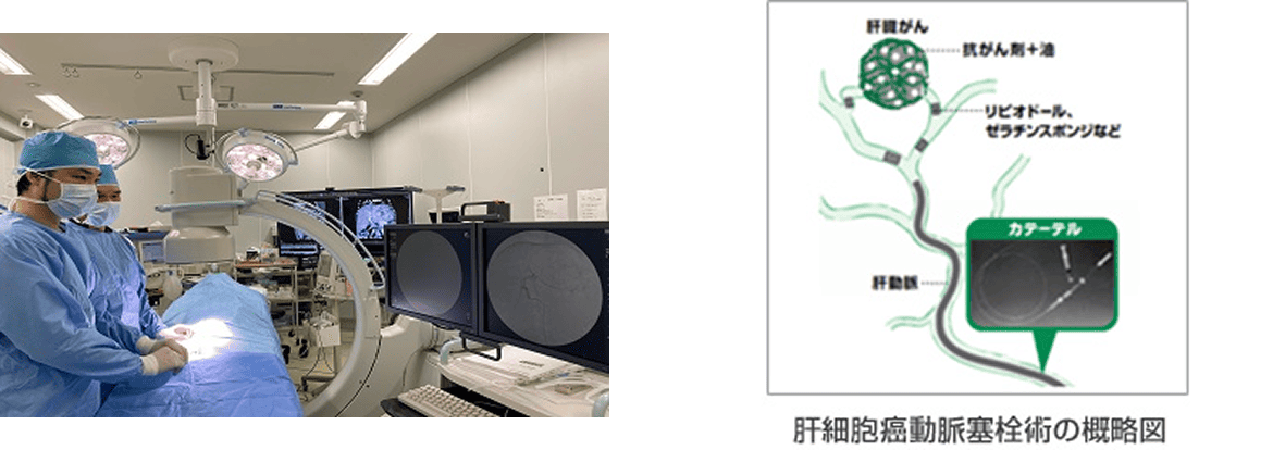 肝細胞癌動脈塞栓術の手術内容