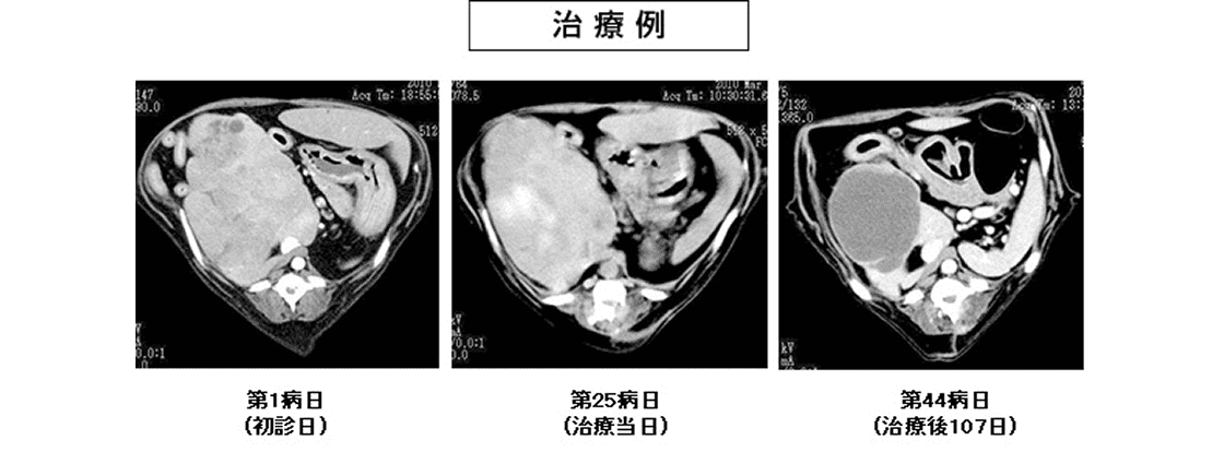 肝細胞癌動脈塞栓術の治療例