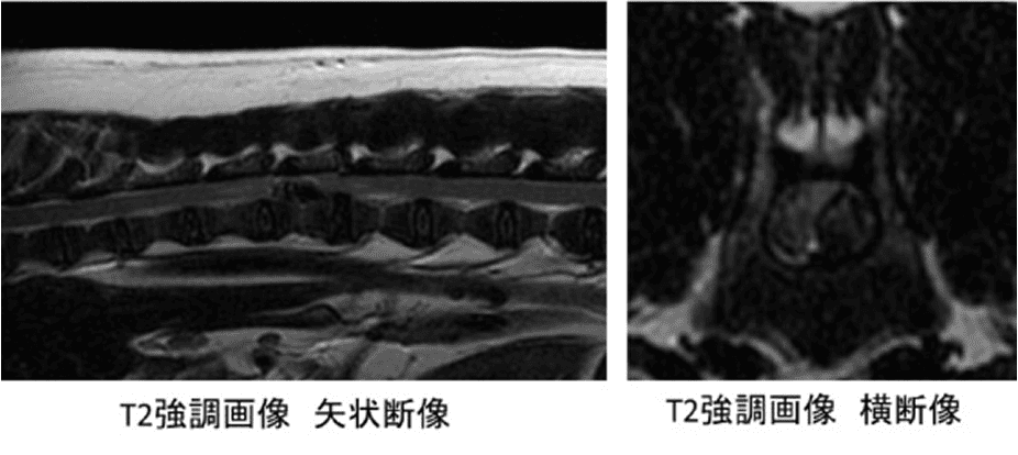胸腰部椎間板ヘルニア