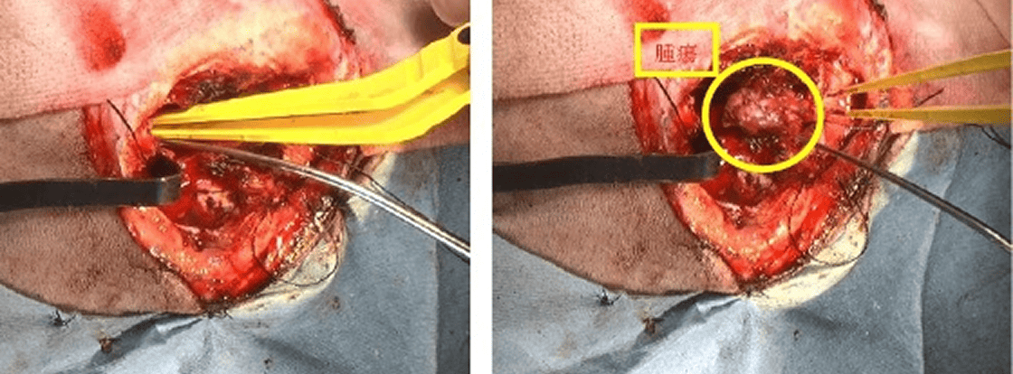 脳内操作(腫瘍摘出)